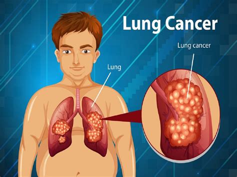 lung cancer symptoms causes diagnosis and treatment