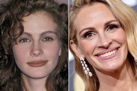 Did Julia Roberts Get Plastic Surgery Including Lips And