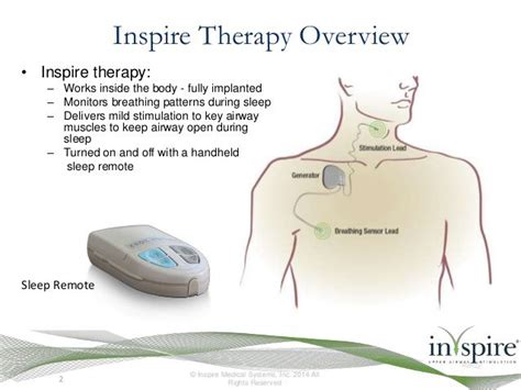 Inspire Therapy An Alternative To The Cpap Machine