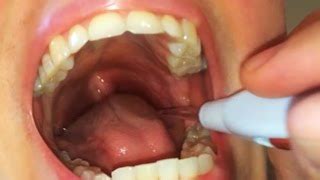 clean  mouth  tonsillectomy howto disinfect