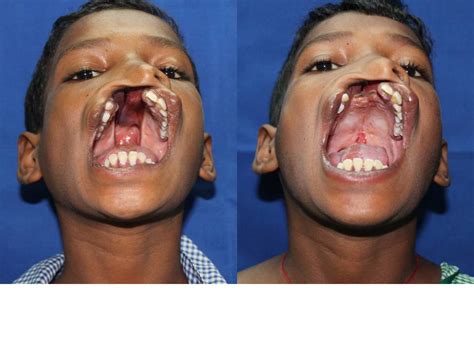 cleft lip  palate surgery  delhi   years   wide cleft