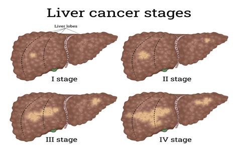 stages  liver cancer usa oncology centers
