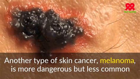 skin cancer symptoms causes symptoms and pictures of