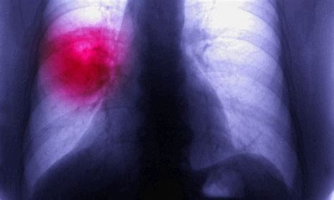 cancer survival rates in england see more patients dying