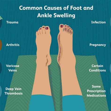 ankles  swelling aimsnow