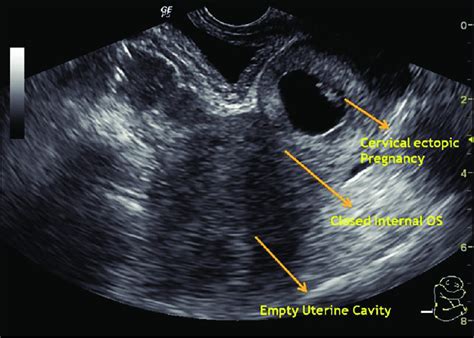 Early Cervical Ectopic Pregnancy With Embryonic Pole Transvaginal