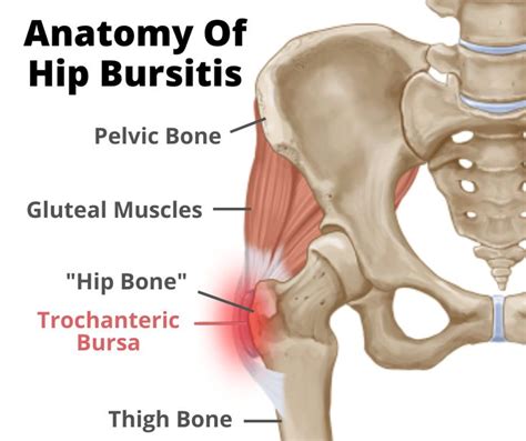 hip bursitis    dysfunction   missing piece