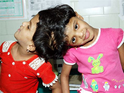 conjoined twins 40 amazing photos graphic images