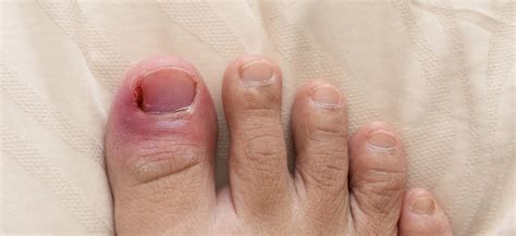 ingrown toenail treatment nh northeast foot ankle