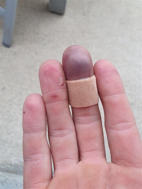 crushed finger rdiagnoseme