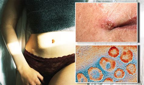 Herpes Sexually Transmitted Virus Is Incurable And Can Cause Painful