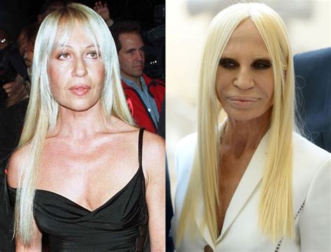 Donatella Versace Before And After Plastic Surgery 04 Celebrity
