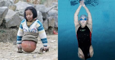 The Inspiring Story Of The Amputee Swimming Champion Who Did Not Lose