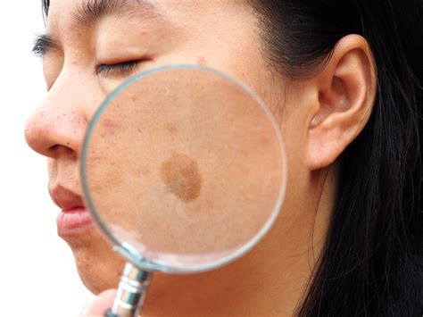 melasma treatment possibilities expand    research