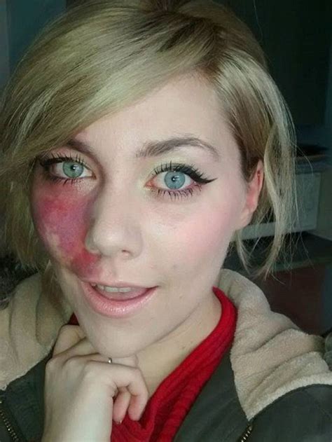 woman with facial birthmark was told she was too ugly for love