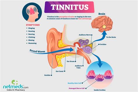 Tinnitus Causes Symptoms And Treatment