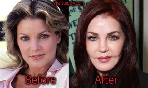 Priscilla Presley Plastic Surgery Before And After