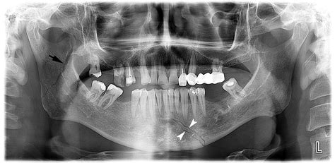 mandibular fracture  ray