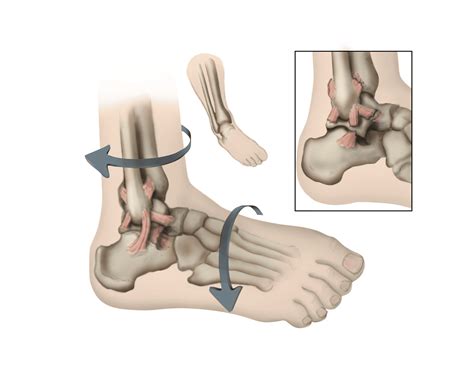 sprained ankle orthoinfo aaos