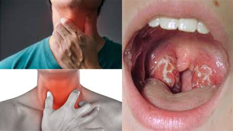 cure  sore throat fast   fix  sore throat bright cures
