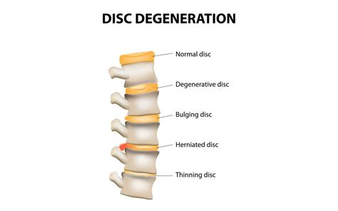 degenerative disc disorder  common   neck   pain