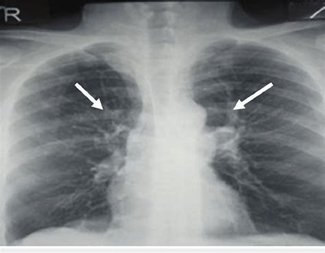 Chest X Ray Showing Linear Opacity Associated With Retraction Signs In