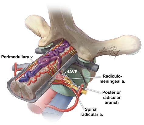spinal av fistula disconnection  neurosurgical atlas  aaron
