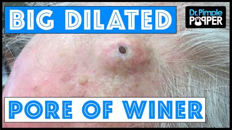 The Biggest Dilated Pore Of Winer Youtube