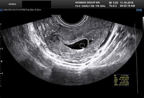 early   gestational sac    ultrasound wallpaper