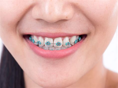 13 Main Things You Need To Know About Getting Braces In Singapore