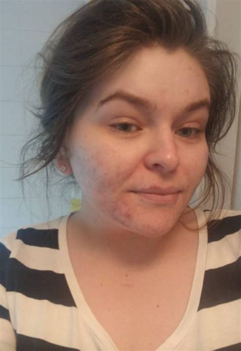 mum who became a recluse due to acne now feels ‘free after finding