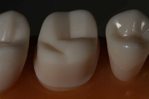 full gold crown preparation maxillary stevenson dental solutions