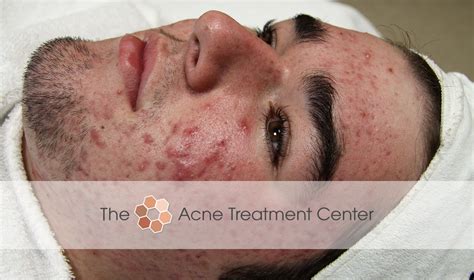 inflamed acne treatment photo acne treatment center portland