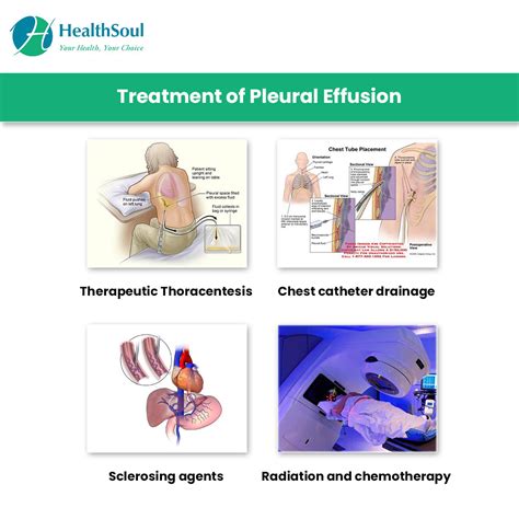 pleural effusion  diagnosis  treatment healthsoul