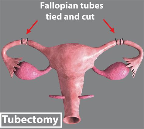 after tubectomy which part of the female reproductive
