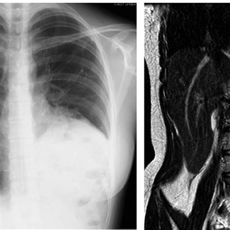 Case 1 Preoperative Chest Radiography A Preoperative Magnetic