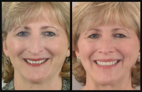 Reverse Aging With Orthodontics At Stone Oak Orthodontics In San