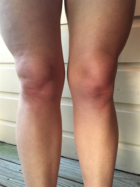 fluid retention joint hypermobility and my knees strength