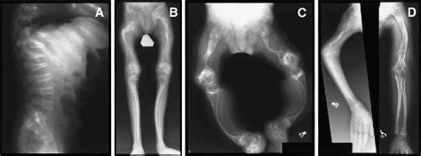 brittle bone disease osteogenesis imperfecta causes symptoms treatment brittle bone disease