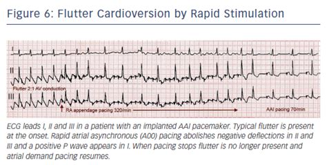 atrial flutter typical and atypical