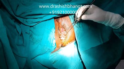 Ignored Piles Best Treatment Dr Ashish Bhanot Youtube