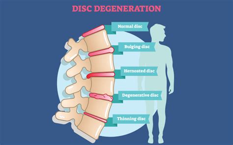 degenerative disk disease front range center  brain spine