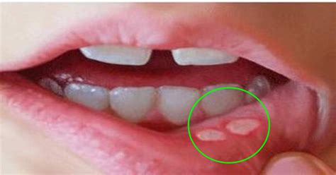 natural ways  heal canker sores quickly