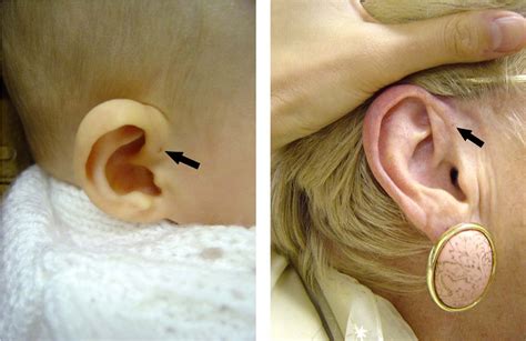 congenital preauricular sinus semantic scholar