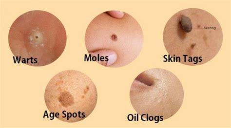 how to remove warts moles skin tags and age spots