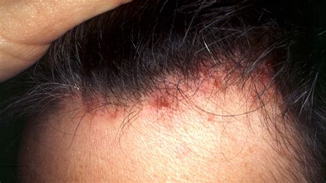 Red Scalp And Hair Loss Bumps On The Scalp Causes Symptoms And My Xxx