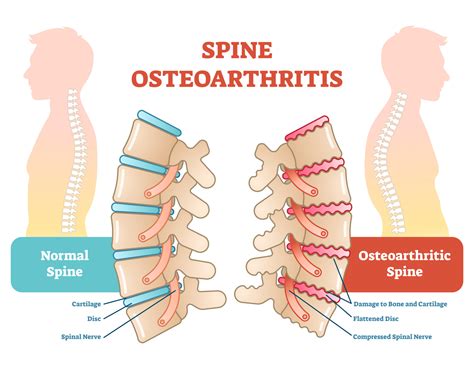 osteoarthritis     affect  spine