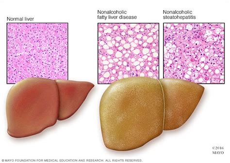 Nonalcoholic Fatty Liver Disease Disease Reference Guide
