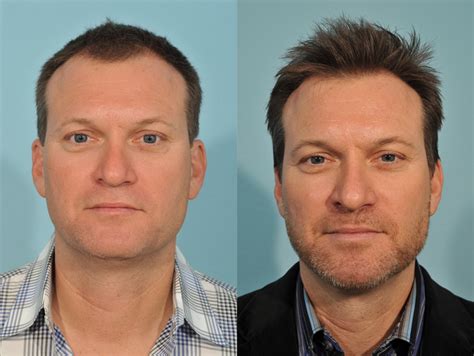 hair transplant before and after 2 jesse e smith md