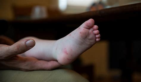 Warning For Hand Foot And Mouth Disease Caribbean Press Release